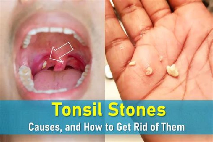 Can 6 year olds get tonsil stones?