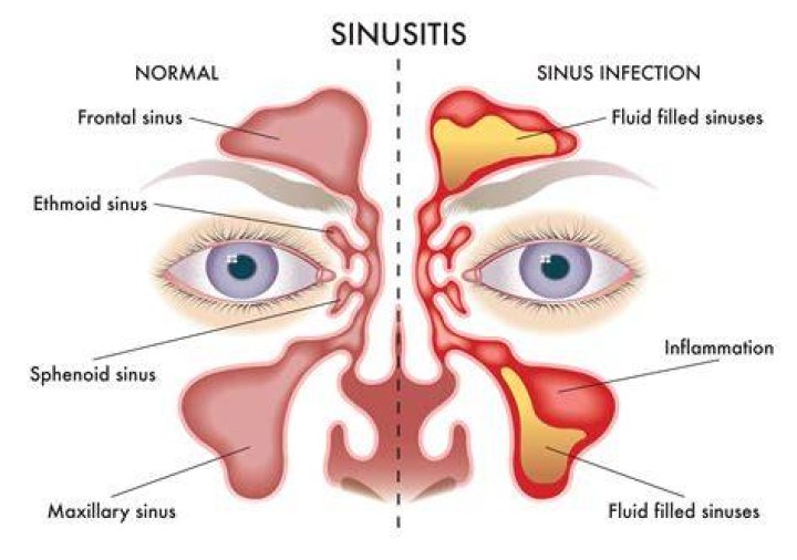 Can sinus cause upset stomach?