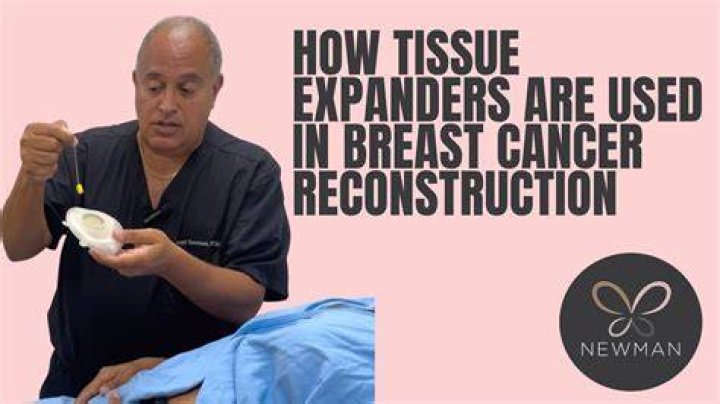 Can tissue expanders cause cancer?