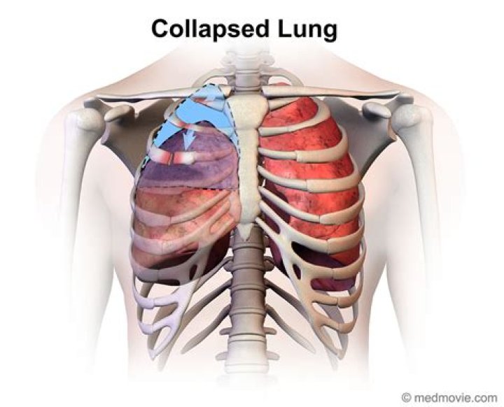 Can you have a collapsed lung and not know?