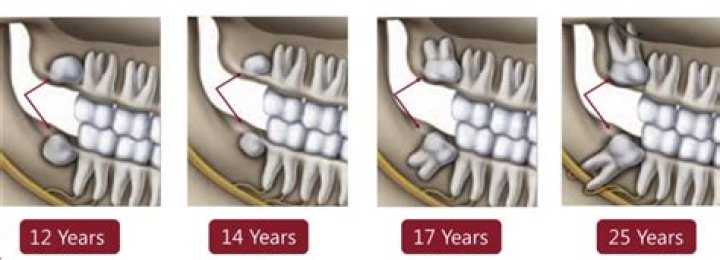 Can your wisdom teeth come in at 34?