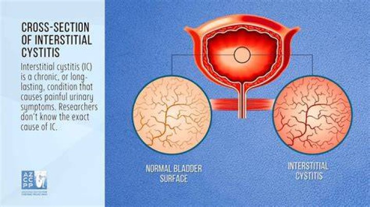 How do you say interstitial cystitis?
