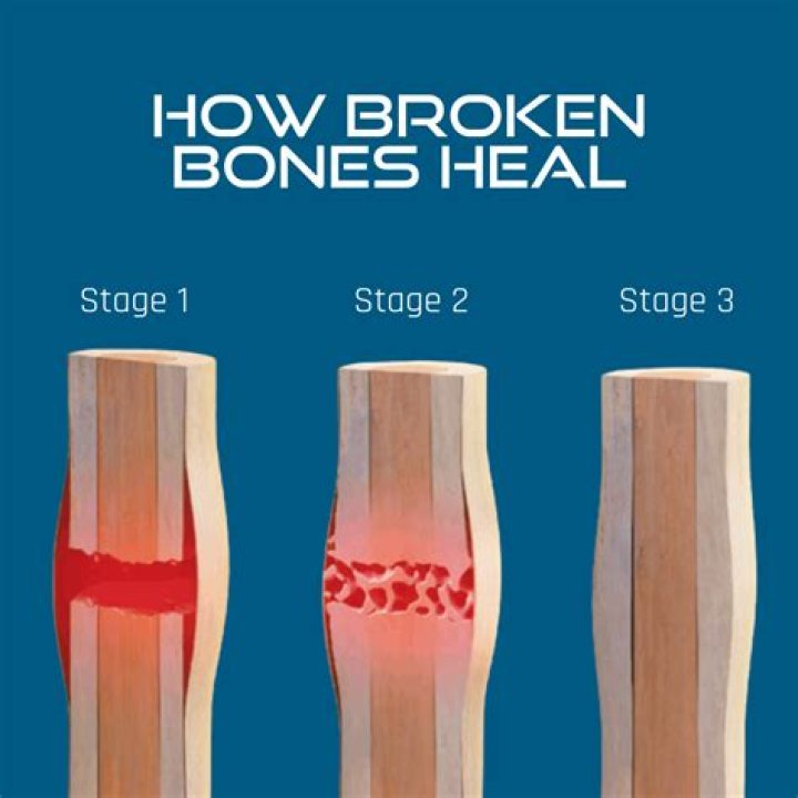 How long does it take for a bruised leg to heal?