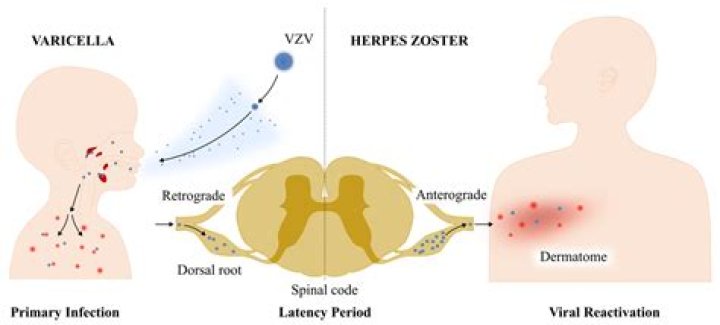 Was bedeutet Varizellen IgG positiv?