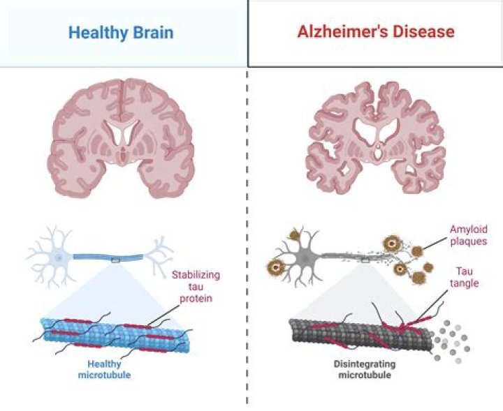 What disease is similar to Alzheimer's?