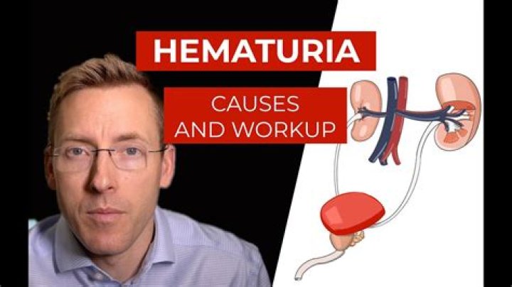 What is exercise induced hematuria?